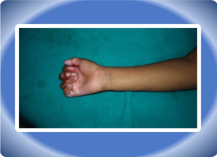 POST BURN CONTRACTURE